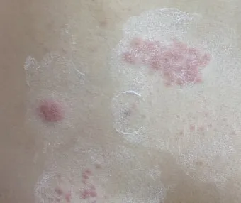 대상포진 치료방법에 대한 총정리 건강 질병관리_25