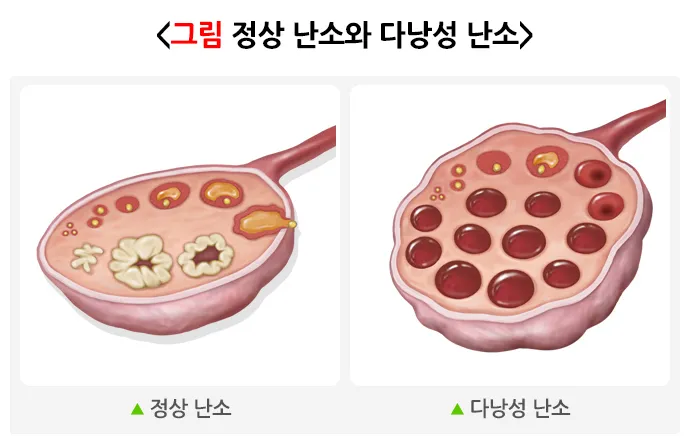다낭성 난소증후군