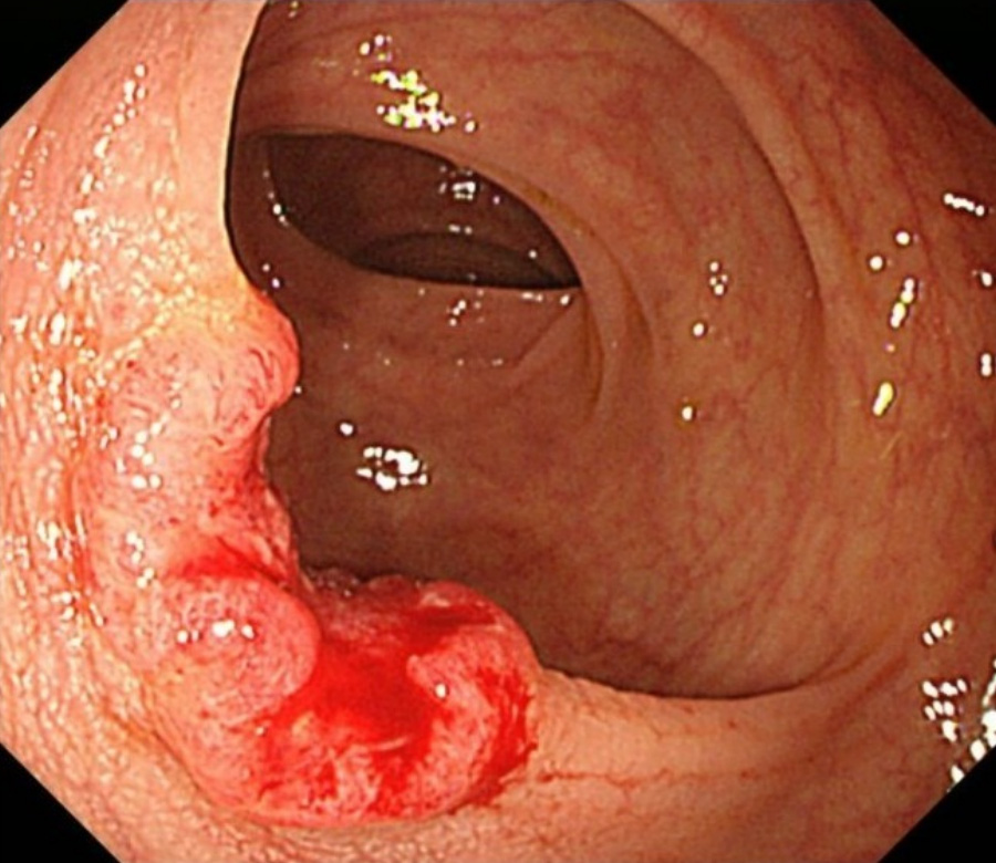 사람의 입에 내시경을 넣고 검진을 진행하는 중에 후두 부분에서 빨간 암덩어리를 발견하고 찍은 사진