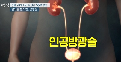 인공방광술