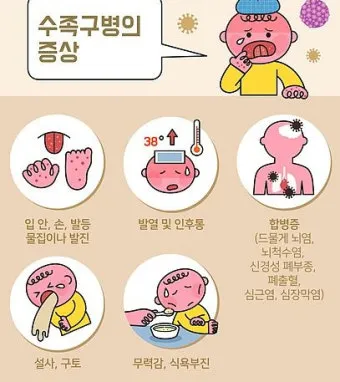 수족구병 증상과 예방 조치 방법 모음_9