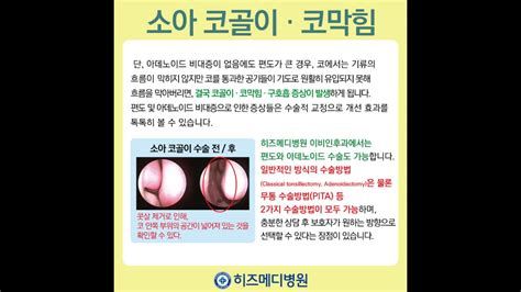 코골이 고치는 법