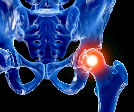 고관절염
