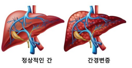 정상적인-간과-비정상적인-간의모습