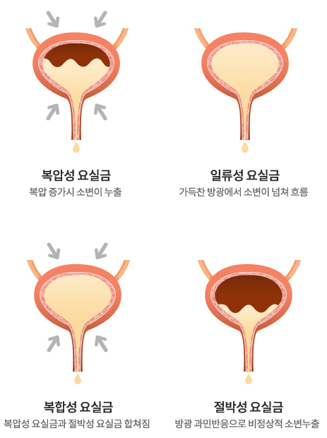 요실금 증상에 따른 종류