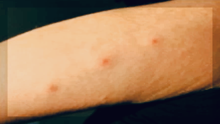 빈대 물리면 증상&amp;#44; 자국