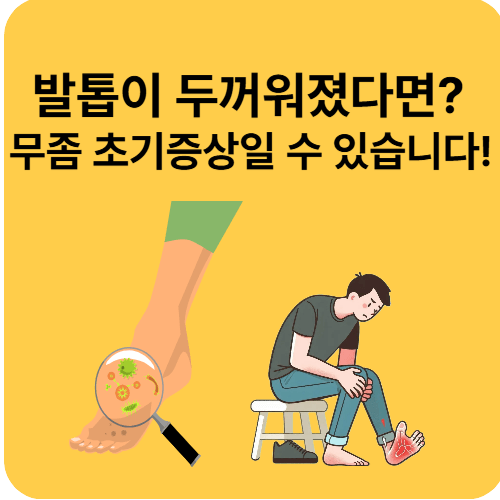 발톱무좀 초기증상과 치료법, 방치하면 생기는 문제는?