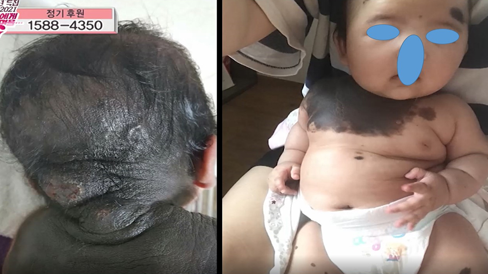 선천성거대모반-흑색종-원인-치료-명의-리스트