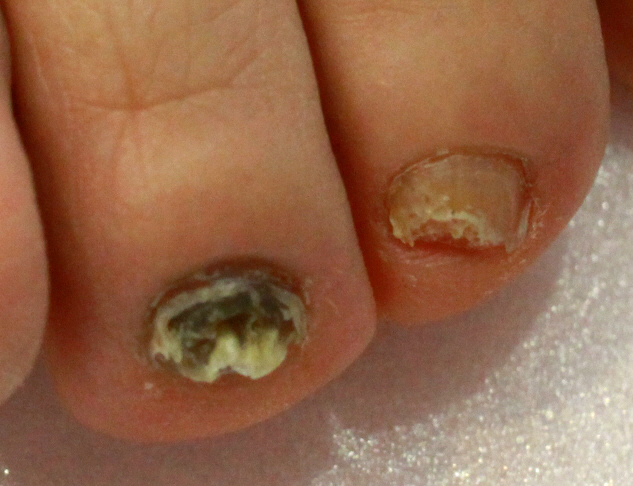 발톱무좀과 치료방법