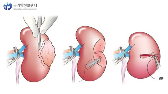 신장암 원인부터 증상·치료·예방까지