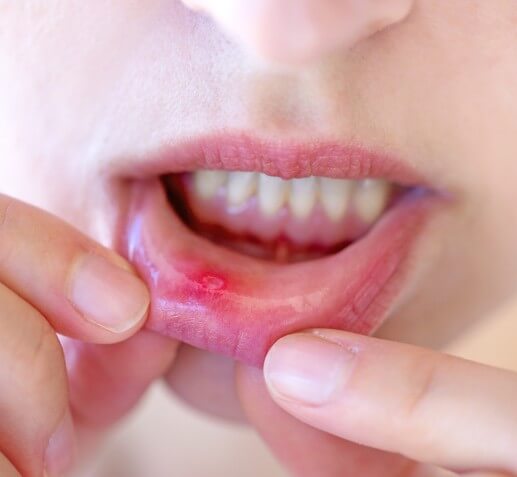 입안에 생긴 구내염