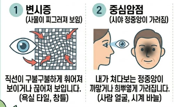 황반변성 증상
