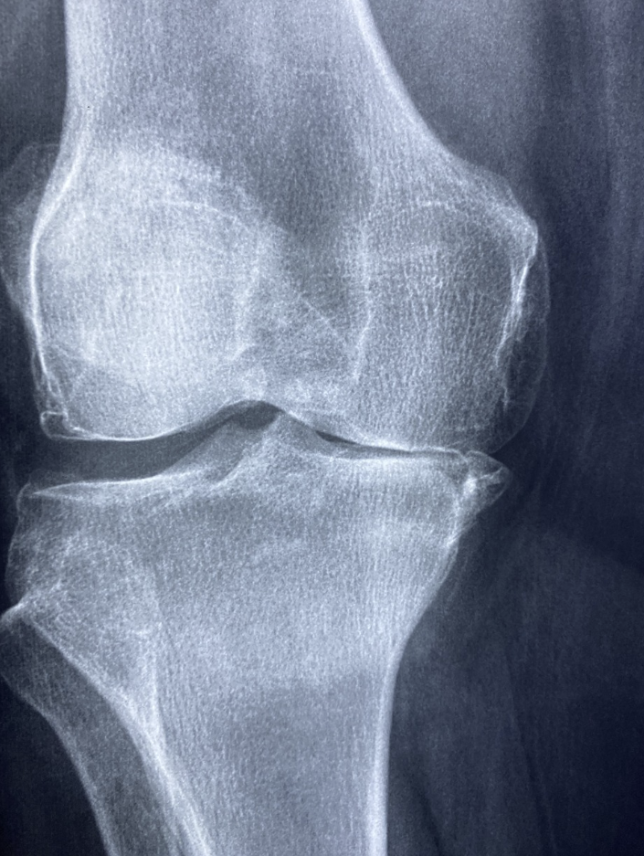 성남시 대상포진 무료접종