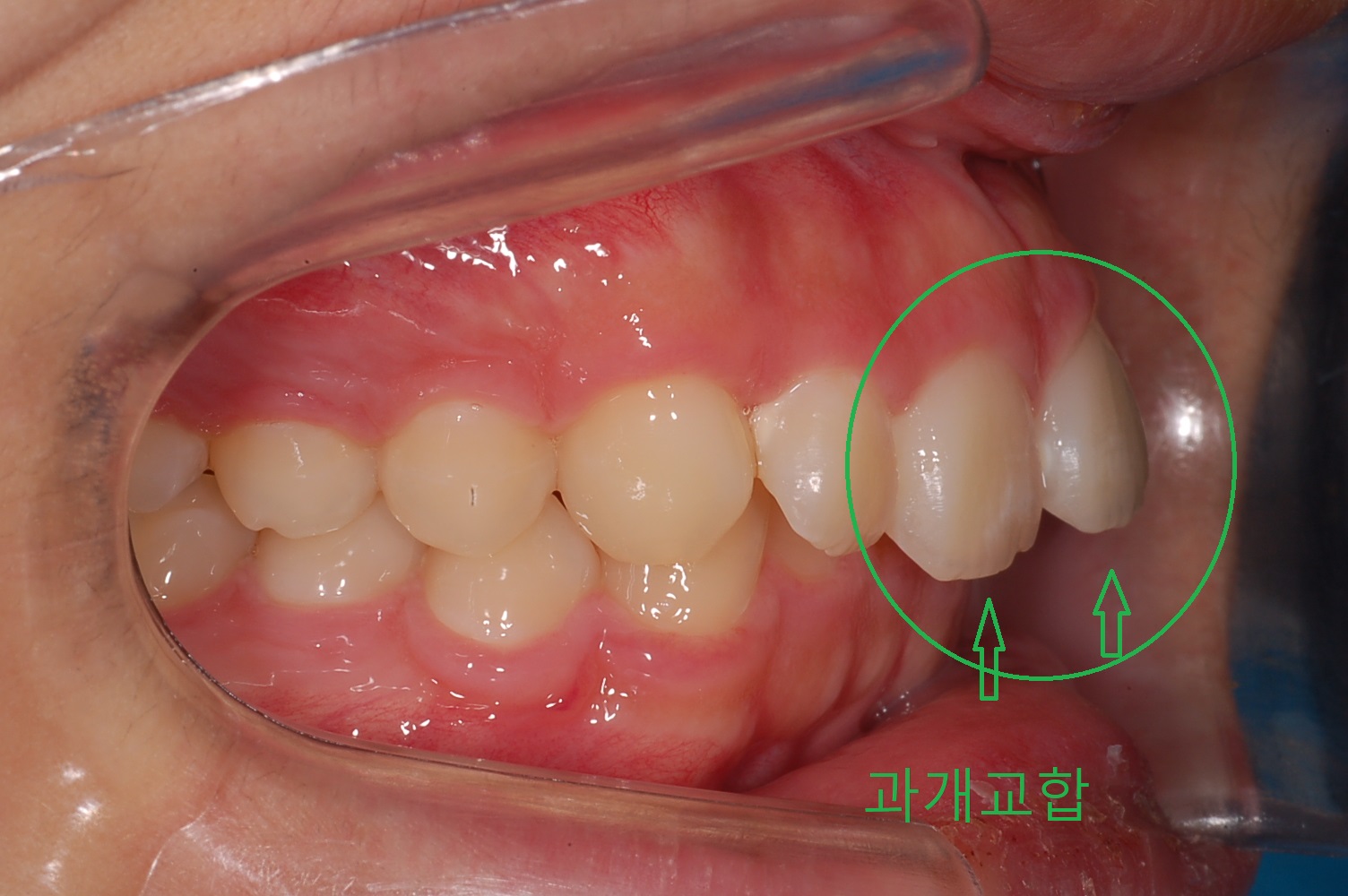 부정교합 가위교합 과개교합 치아교정 후기1