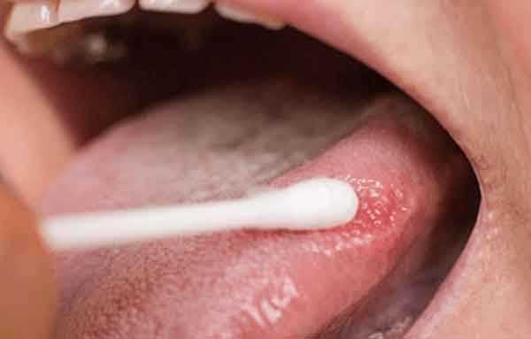 면봉으로 없애는 모습