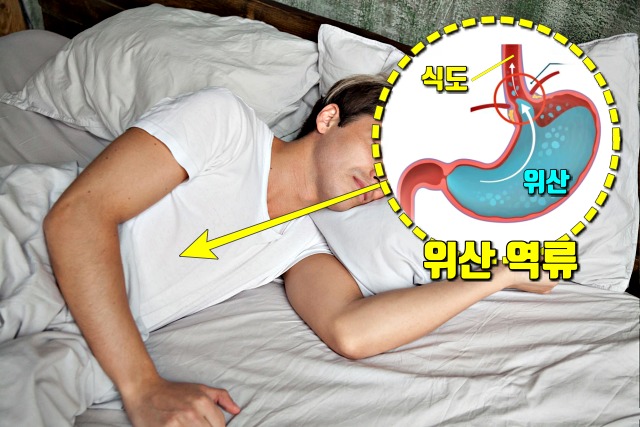 속쓰림,왼쪽으로 누워자면,위안좋을때증상,팁줌