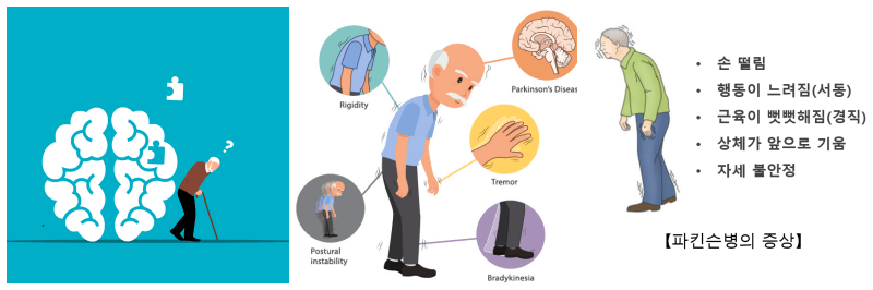 파킨슨병 관련 사진 3개