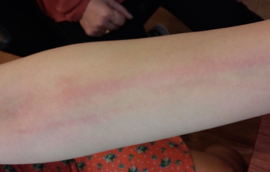 피부묘기증과 두드러기 관련 사진