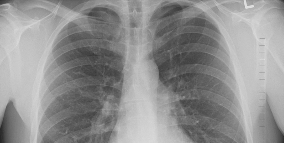 꼬막 효능은 뼈 건강에 좋다