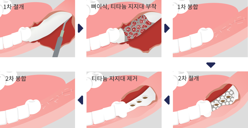 무절개 임플란트