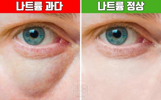 눈 붓기 나트륨과다섭취