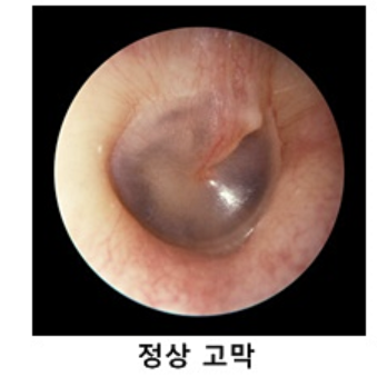 중이염 증상 1