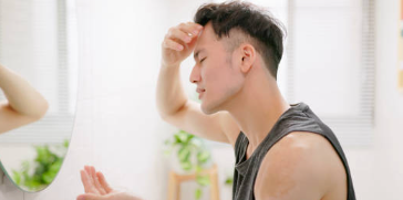 남성 탈모