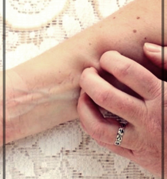 성인 농가진: 원인, 증상, 및 치료 방법