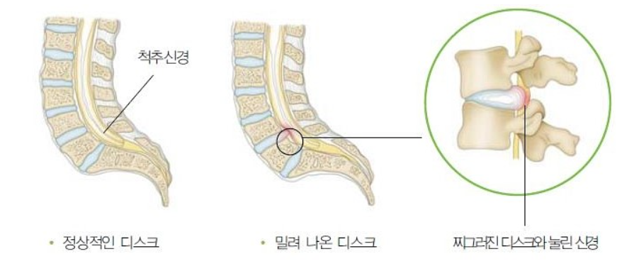 허리디스크 설명사진