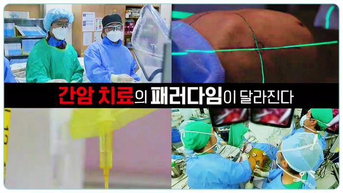 제731화-EBS-명의-다양한-간암-치료-신기술