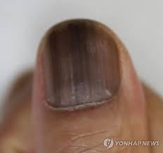 손톱이 검게 변하는 원인과 대처법