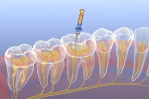 신경치료-후-통증