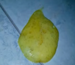 공복성 위액 구토 사진