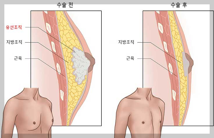 남성여유증 수술 전, 후