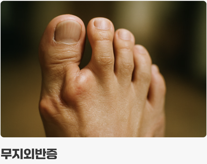 겉모습의 차이, 붉게 부어오름 vs 뼈가 튀어나옴