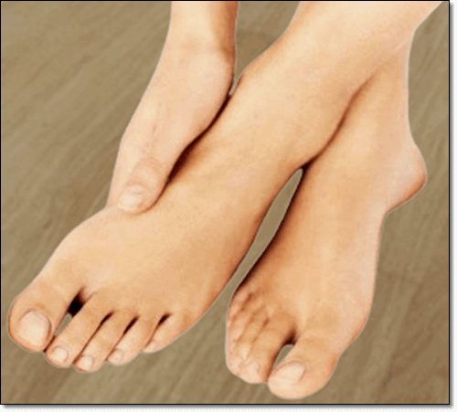 발 통풍 환자