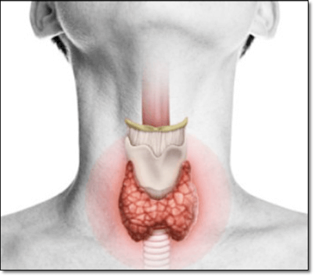 갑상선 기능 저하증