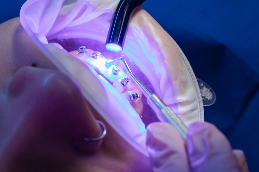 임플란트의 종류에 관련된 사진3