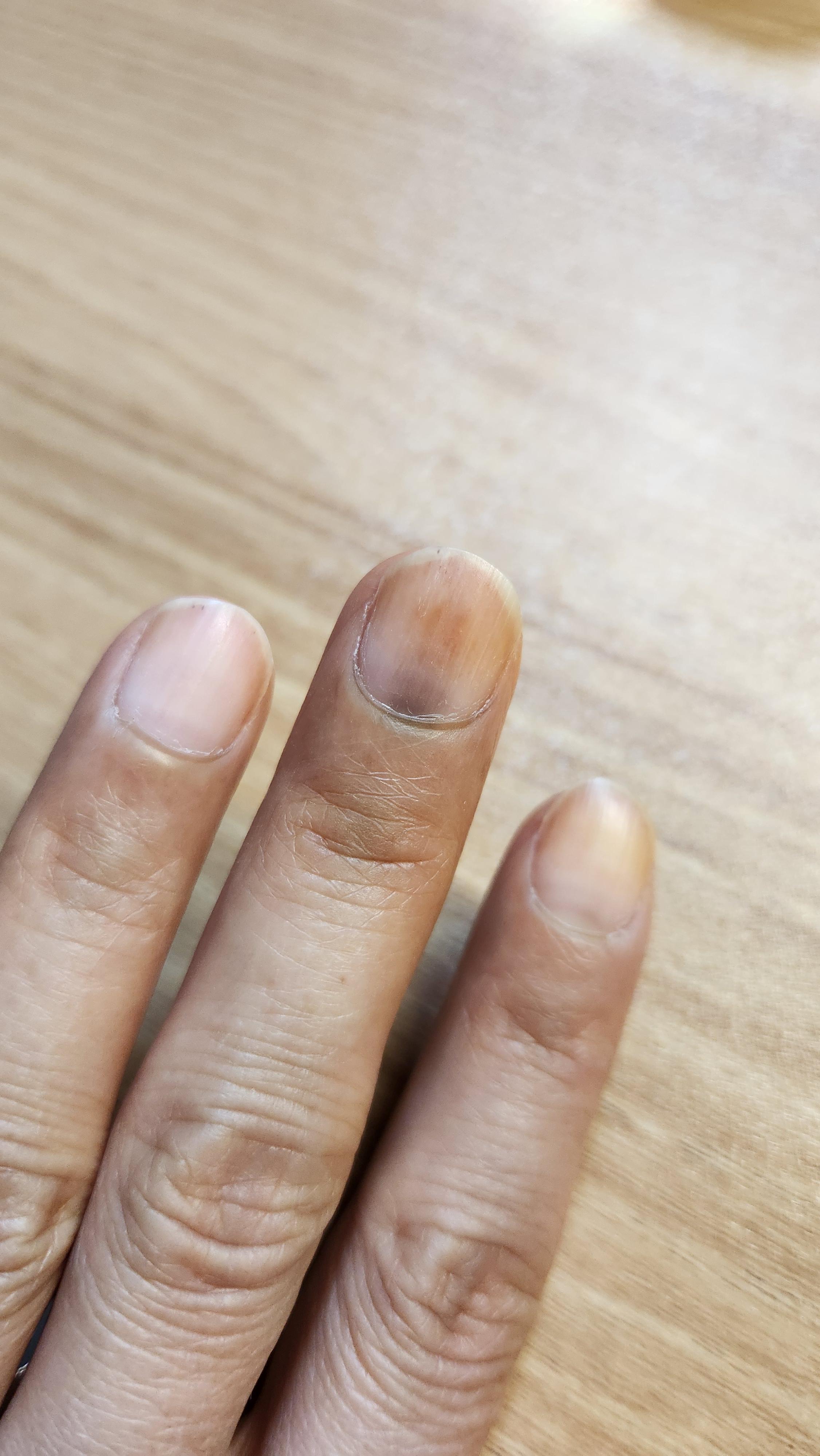 유방암 항암 부작용