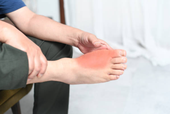 통풍의 원인과 증상, 진단, 치료와 예방 방법, 합병증