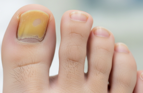 발톱무좀-원인-초기증상-자연치료-전염여부-해결