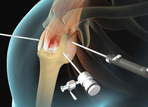 회전근개파열 수술후 회복기간