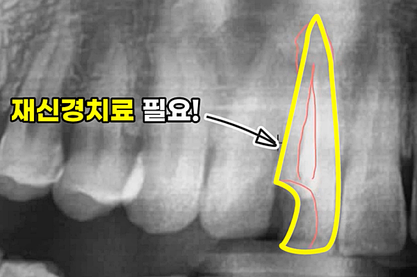 재신경치료, 왜 중요할까요?_출처:유튜브라이브치과병원