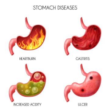 위궤양 - 생활 습관이 불러오는 위장의 경고