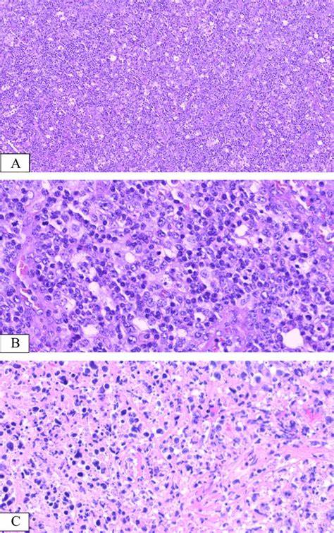 전염단핵구증과 림프구 증식질환의 감별 진단