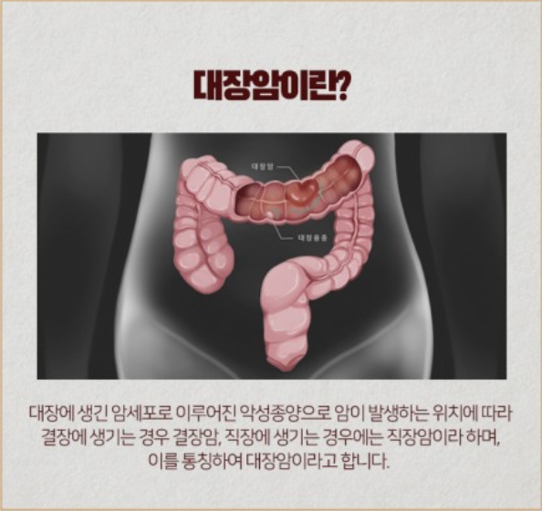 대장암-위치-해부구조