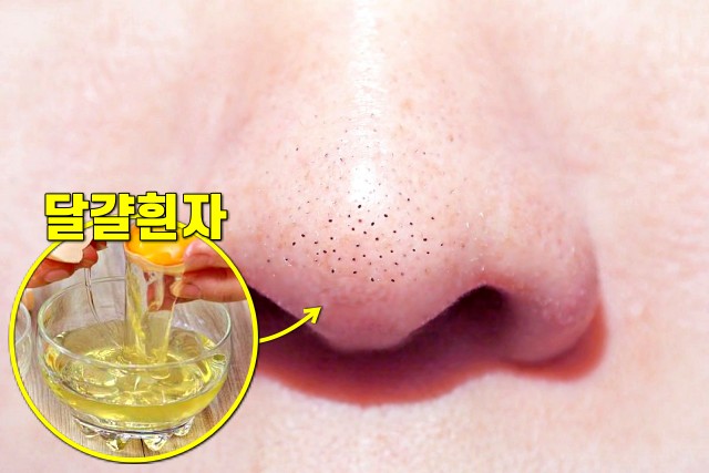 코 피지 제거법, 코 블랙헤드 없애는 방법, 달걀흰자팩, 팁줌
