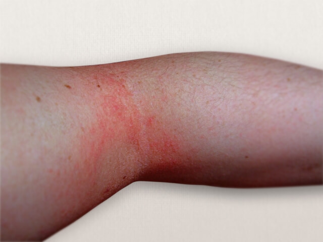 아토피피부염의 근본 원인과 효과적인 치료 방법