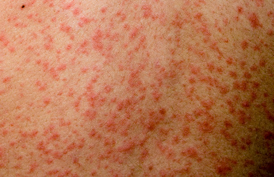 홍역-증상 예방접종