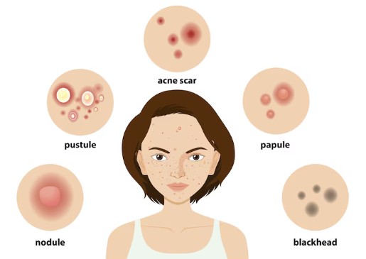 대상포진-예방-접종-비용-가격-3